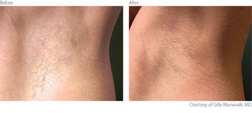 Laser Hair Removal Before and After Photo by Original Skin Med Spa and Laser Clinic in Broomfield CO