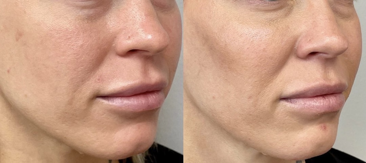 Voluma and Vollure treatment before and after photos of Original Skin Med Spa and Laser Clinic