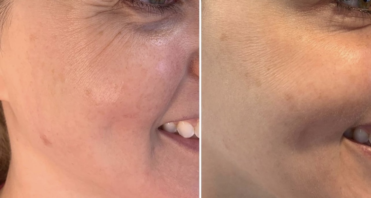 Voluma and Vollure treatment before and after photos of Original Skin Med Spa and Laser Clinic