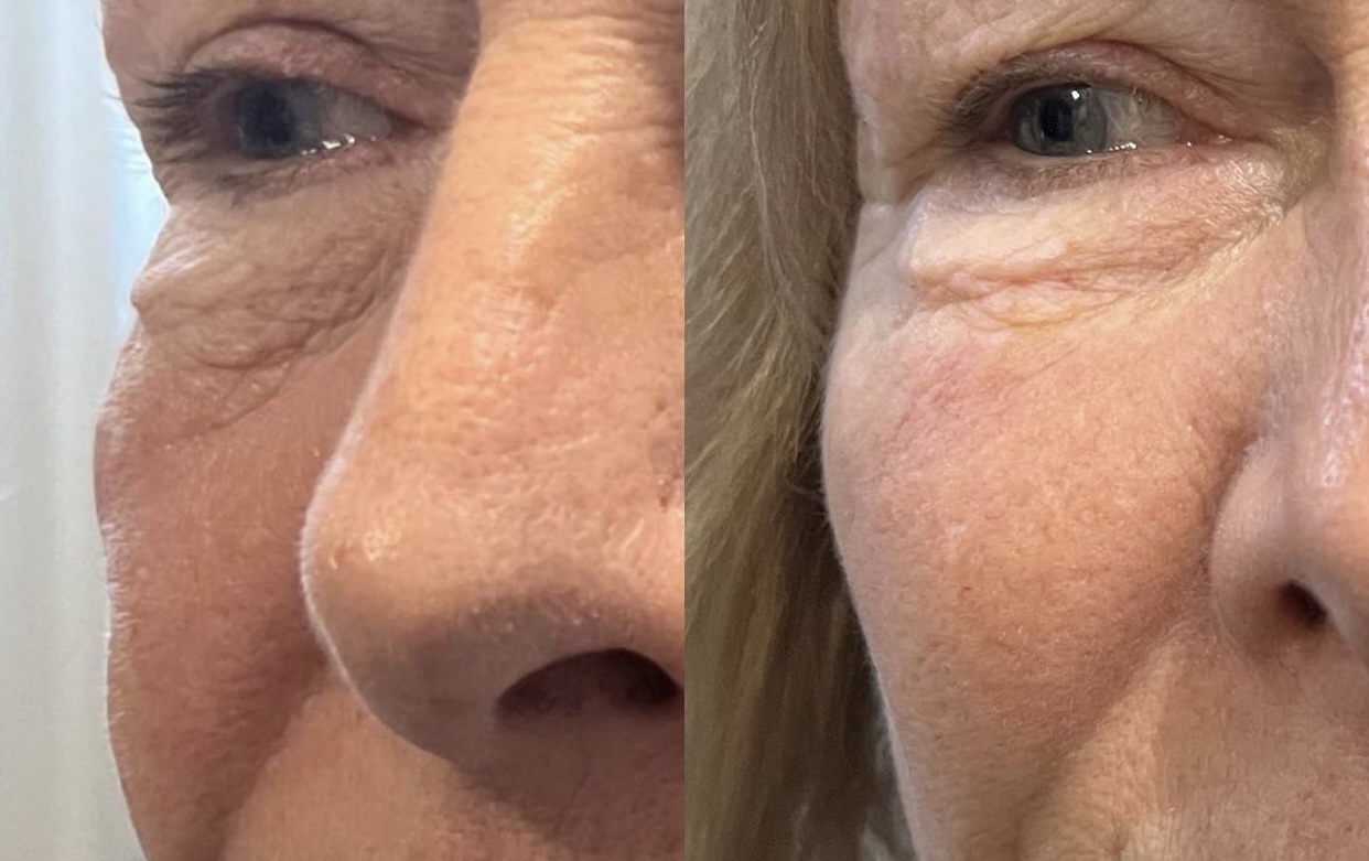 Voluma and Vollure treatment before and after photos of Original Skin Med Spa and Laser Clinic