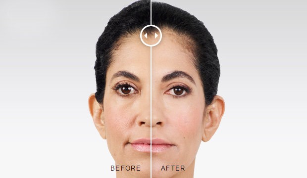 Juvederm® Injections Before and After Photo by Original Skin Med Spa and Laser Clinic in Broomfield CO