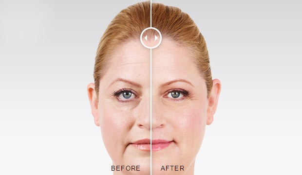 Juvederm® Injections Before and After Photo by Original Skin Med Spa and Laser Clinic in Broomfield CO