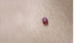 Cherry Angioma