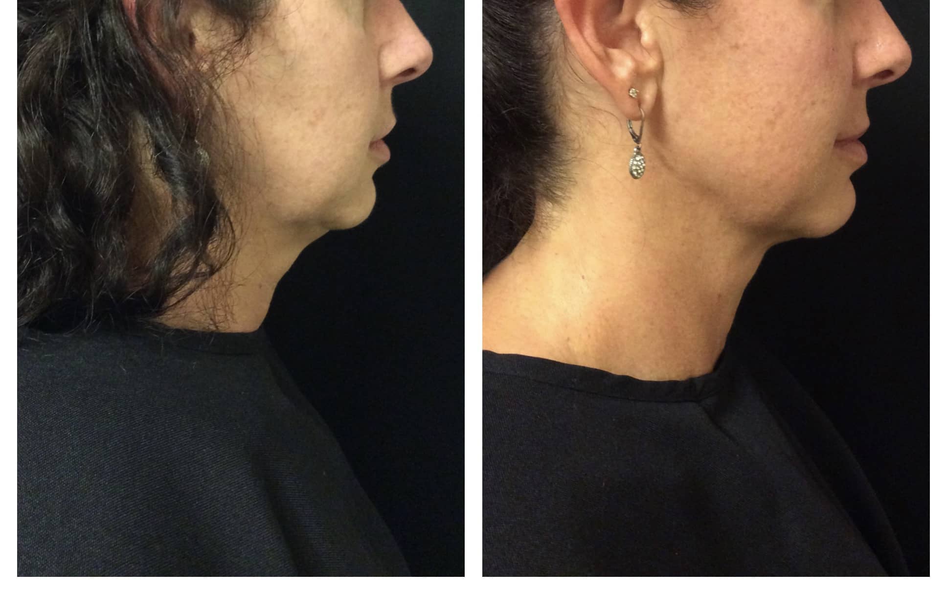 Double chin treatment before and after photos of Original Skin Med Spa and Laser Clinic