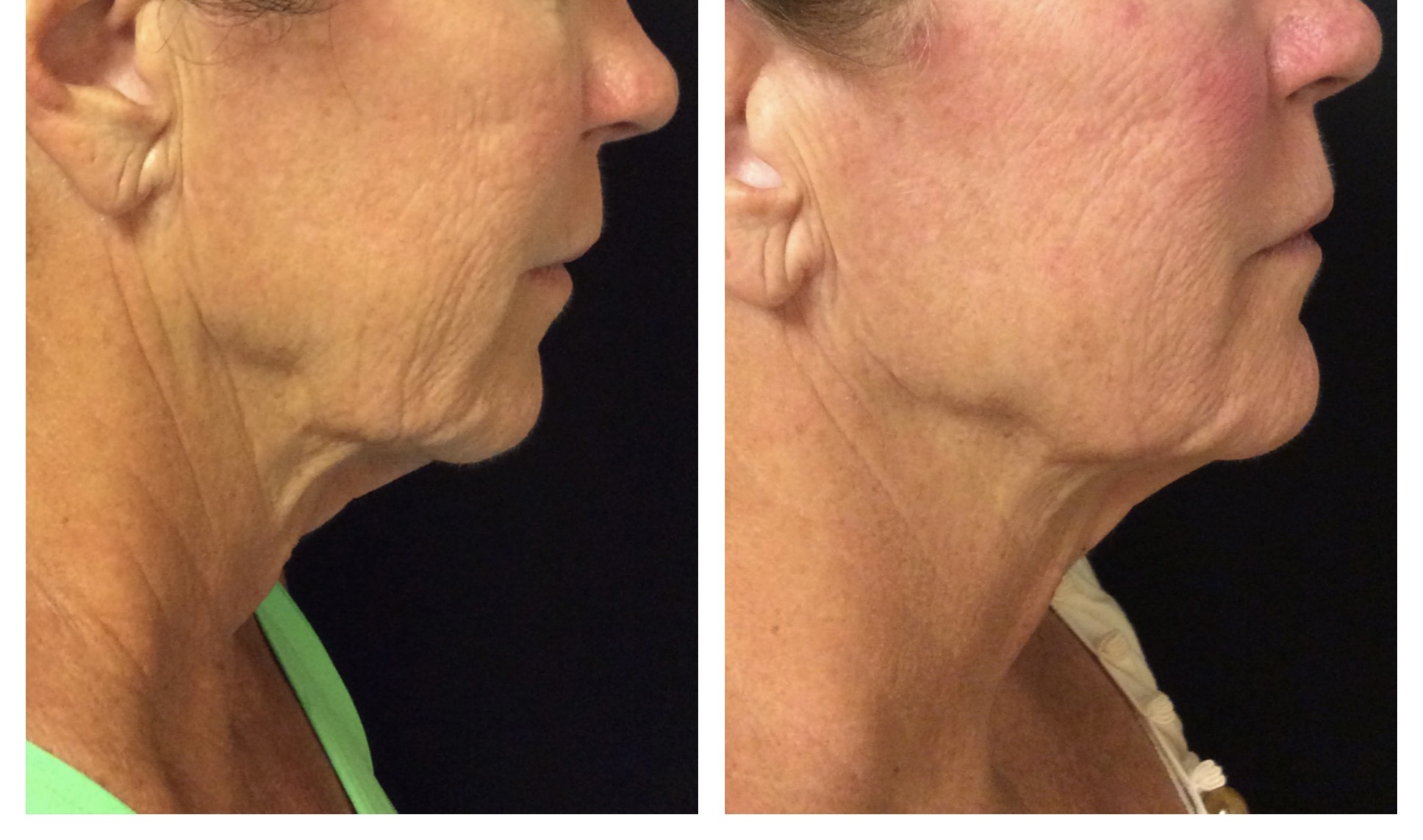 Profound RF Microneedling treatment before and after photos of Original Skin Med Spa and Laser Clinic