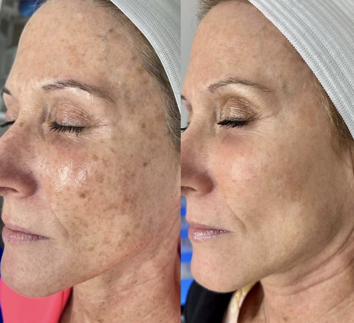 IPL Photofacial treatment before and after photos of Original Skin Med Spa and Laser Clinic