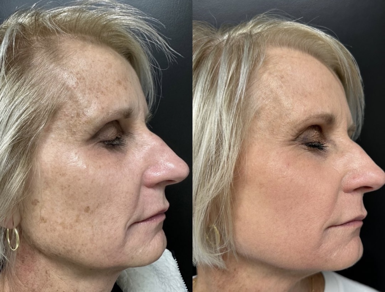 IPL Photofacial treatment before and after photos of Original Skin Med Spa and Laser Clinic