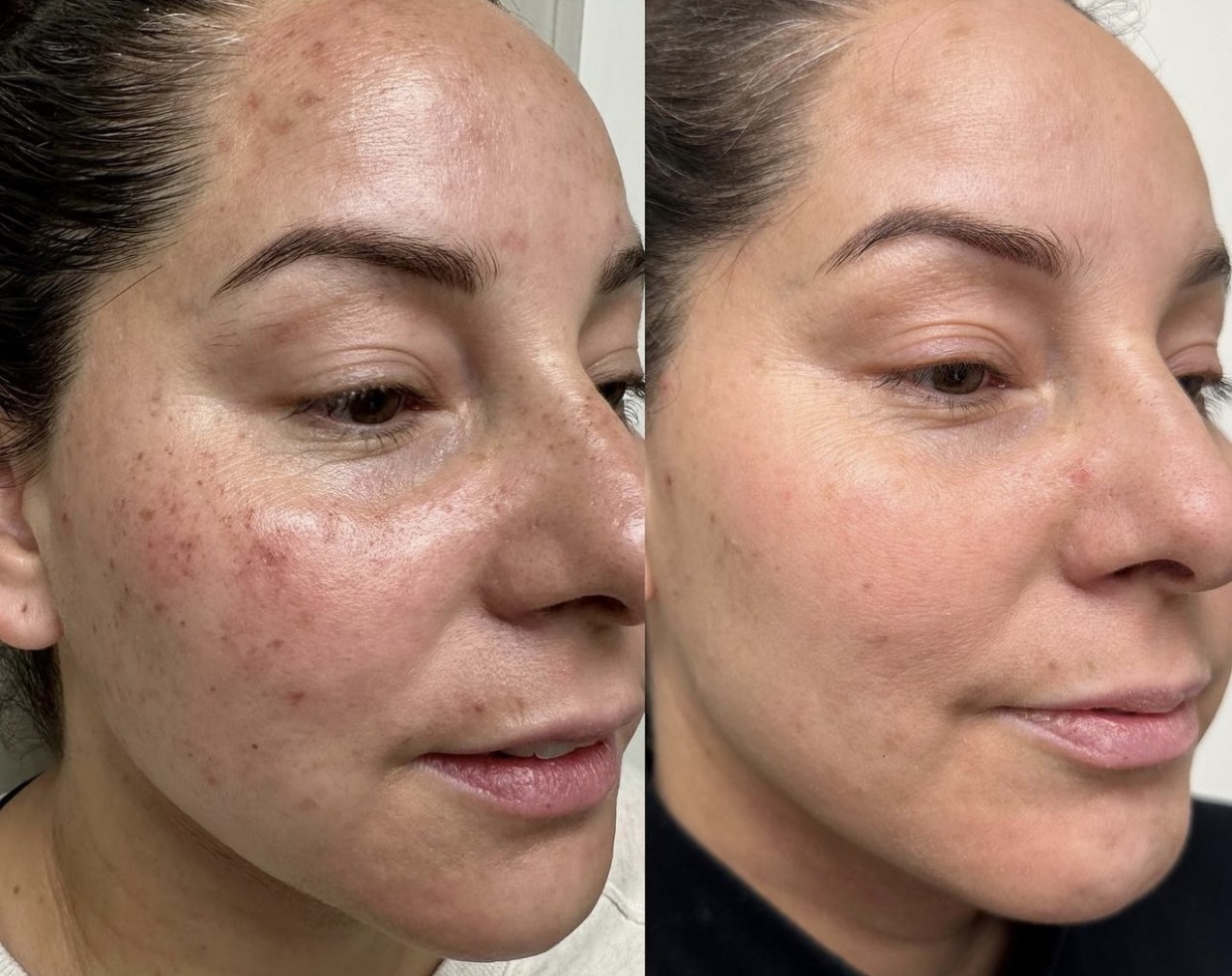 IPL Photofacial treatment before and after photos of Original Skin Med Spa and Laser Clinic