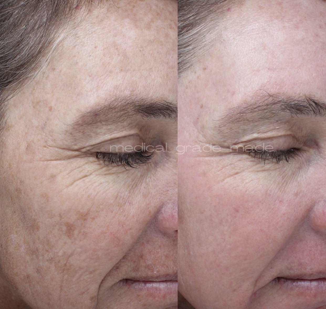 IPL Photofacial treatment before and after photos of Original Skin Med Spa and Laser Clinic