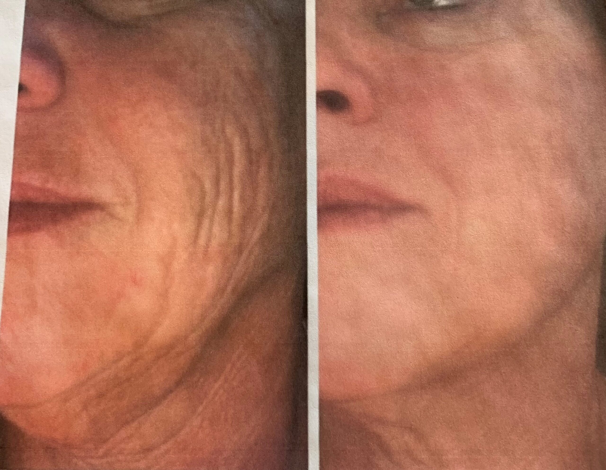 Profound RF Microneedling treatment before and after photos of Original Skin Med Spa and Laser Clinic