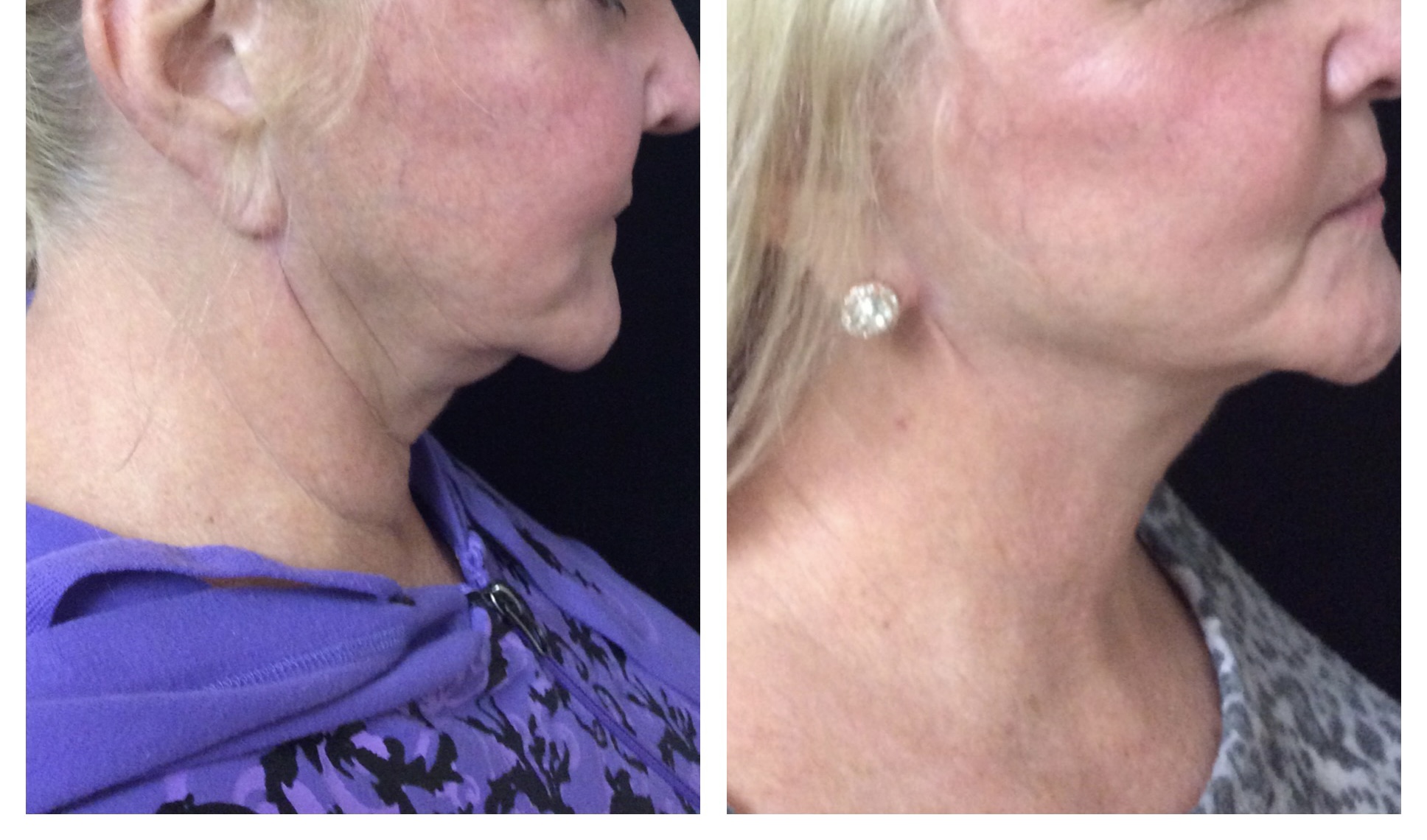 Profound RF Microneedling treatment before and after photos of Original Skin Med Spa and Laser Clinic