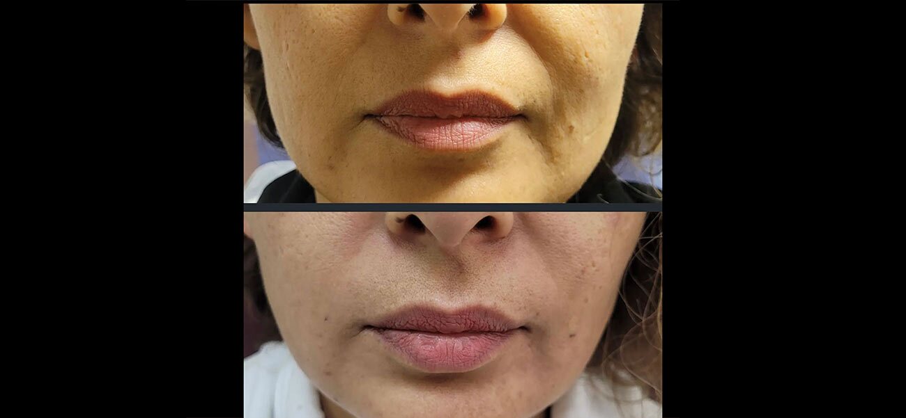 Nasalabial treatment done with Juvederm at Original Skin Med Spa and Laser Clinic located in Broomsfield, Colorado