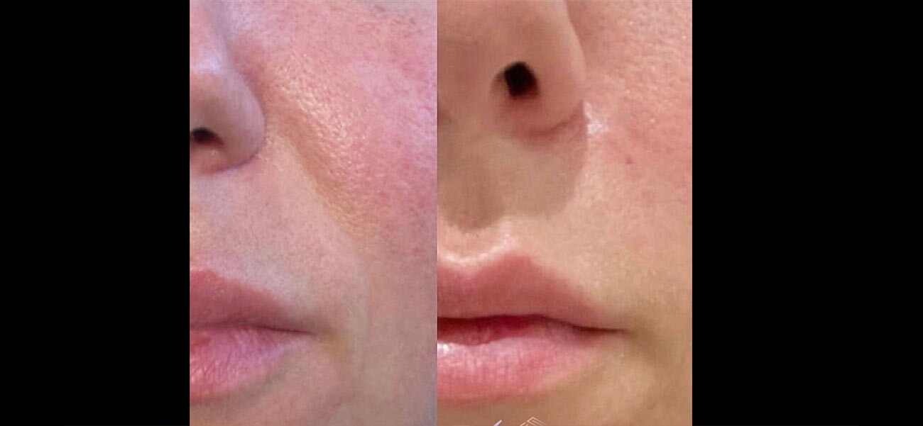 Nasalabial treatment done with Juvederm at Original Skin Med Spa and Laser Clinic located in Broomsfield, Colorado