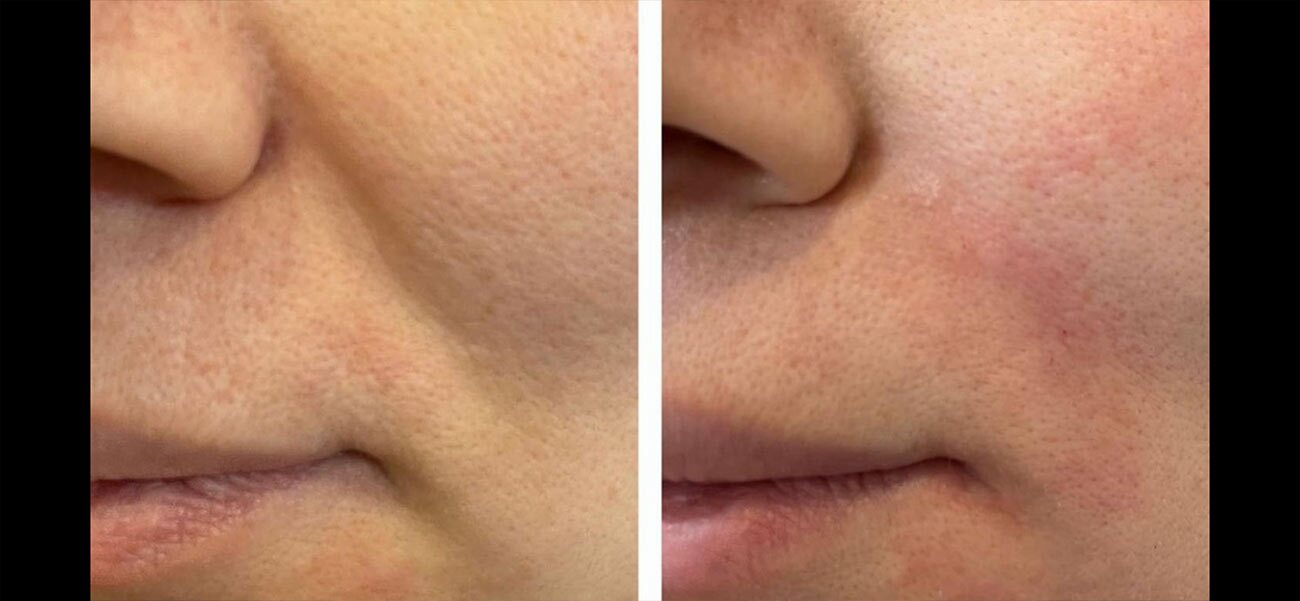 Nasalabial treatment done with Juvederm at Original Skin Med Spa and Laser Clinic located in Broomsfield, Colorado