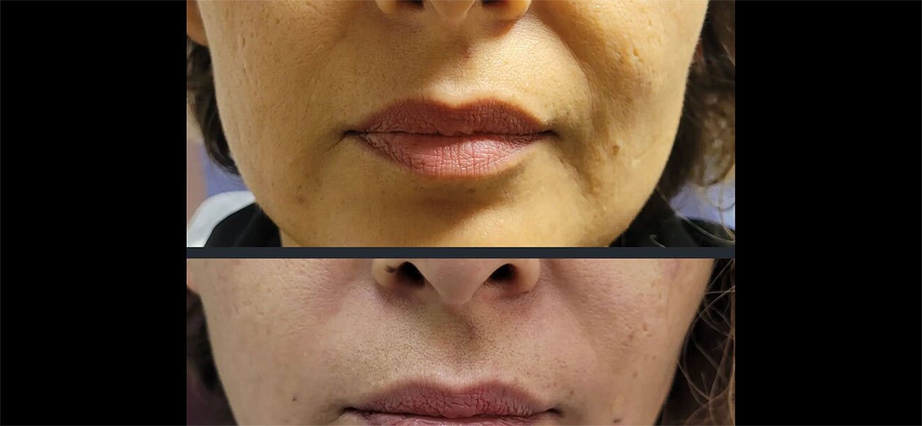 Nasalabial treatment done with Juvederm at Original Skin Med Spa and Laser Clinic located in Broomsfield, Colorado