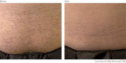 Laser Hair Removal Before and After Photo by Original Skin Med Spa and Laser Clinic in Broomfield CO