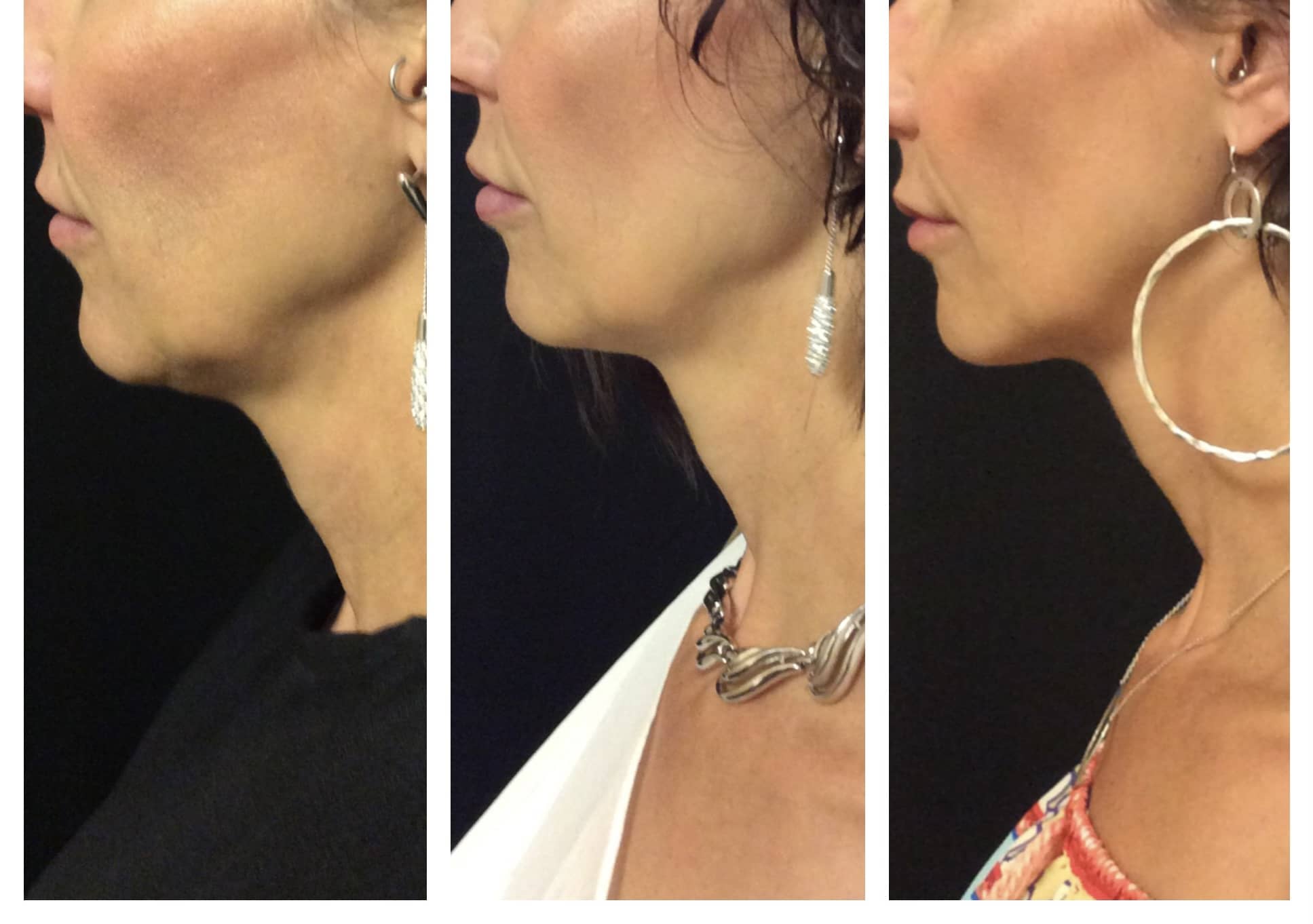 Double chin treatment before and after photos of Original Skin Med Spa and Laser Clinic