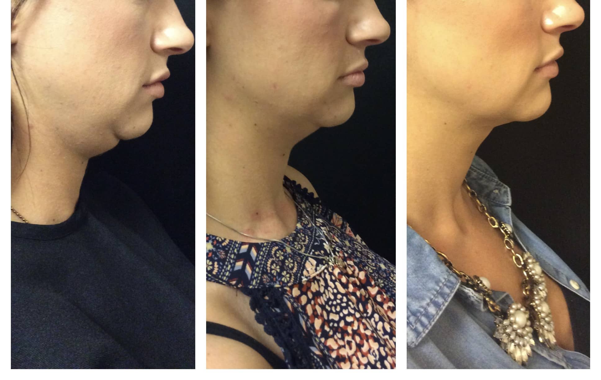 Double chin treatment before and after photos of Original Skin Med Spa and Laser Clinic