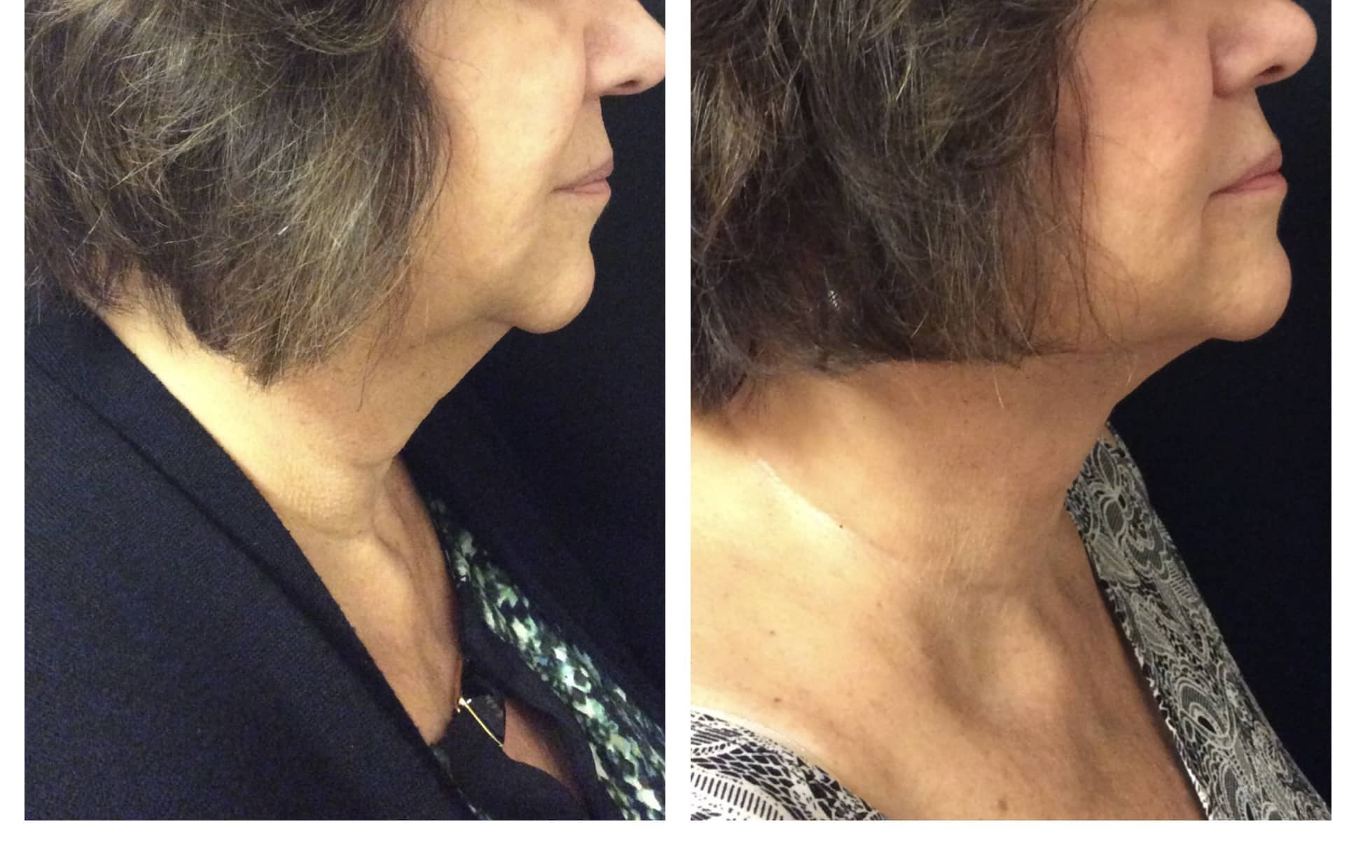 Double chin treatment before and after photos of Original Skin Med Spa and Laser Clinic