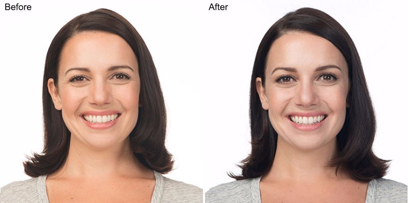 BOTOX® Cosmetic Injections Before and After Photo by Original Skin Med Spa and Laser Clinic in Broomfield CO BOTOX® Cosmetic Injections Before and After Photo by Original Skin Med Spa and Laser Clinic in Broomfield CO