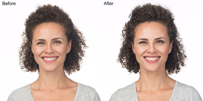 BOTOX® Cosmetic Injections Before and After Photo by Original Skin Med Spa and Laser Clinic in Broomfield CO BOTOX® Cosmetic Injections Before and After Photo by Original Skin Med Spa and Laser Clinic in Broomfield CO