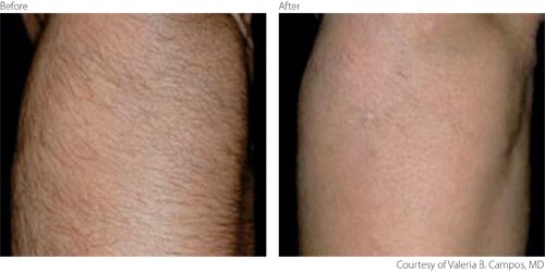 Laser Hair Removal Before and After Photo by Original Skin Med Spa and Laser Clinic in Broomfield CO Laser Hair Removal Before and After Photo by Original Skin Med Spa and Laser Clinic in Broomfield CO