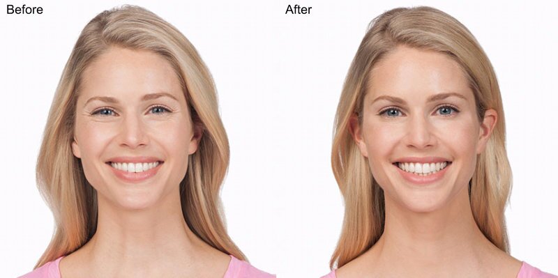 BOTOX® Cosmetic Injections Before and After Photo by Original Skin Med Spa and Laser Clinic in Broomfield CO