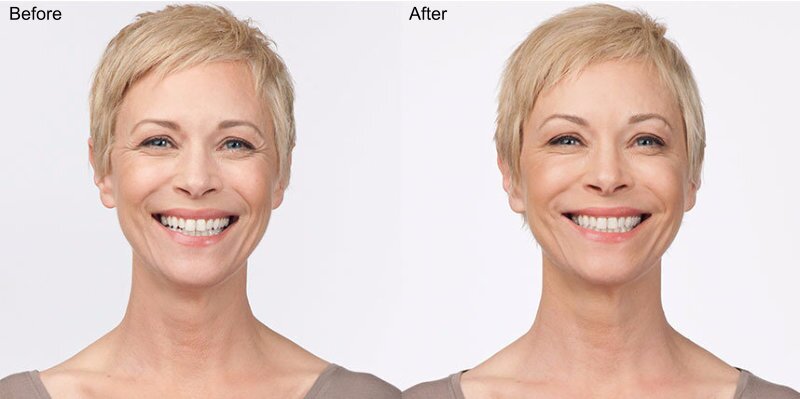 BOTOX® Cosmetic Injections Before and After Photo by Original Skin Med Spa and Laser Clinic in Broomfield CO