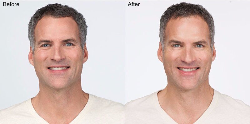 BOTOX® Cosmetic Injections Before and After Photo by Original Skin Med Spa and Laser Clinic in Broomfield CO BOTOX® Cosmetic Injections Before and After Photo by Original Skin Med Spa and Laser Clinic in Broomfield CO
