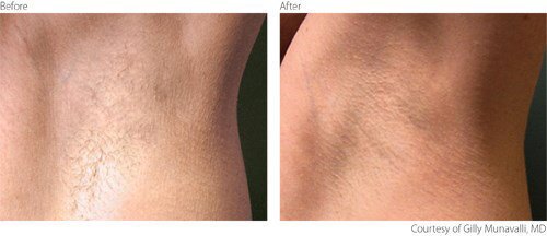 Laser Hair Removal Before and After Photo by Original Skin Med Spa and Laser Clinic in Broomfield CO Laser Hair Removal Before and After Photo by Original Skin Med Spa and Laser Clinic in Broomfield CO
