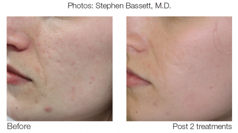 eMatrix Sublative Rejuvenation Before and After Photo by Original Skin Med Spa and Laser Clinic in Broomfield CO eMatrix Sublative Rejuvenation Before and After Photo by Original Skin Med Spa and Laser Clinic in Broomfield CO