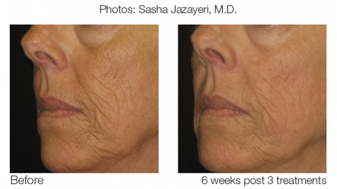 eMatrix Sublative Rejuvenation Before and After Photo by Original Skin Med Spa and Laser Clinic in Broomfield CO eMatrix Sublative Rejuvenation Before and After Photo by Original Skin Med Spa and Laser Clinic in Broomfield CO