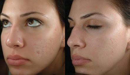 eMatrix Sublative Rejuvenation Before and After Photo by Original Skin Med Spa and Laser Clinic in Broomfield CO eMatrix Sublative Rejuvenation Before and After Photo by Original Skin Med Spa and Laser Clinic in Broomfield CO