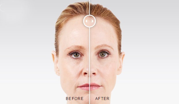 Juvederm® Injections Before and After Photo by Original Skin Med Spa and Laser Clinic in Broomfield CO Juvederm® Injections Before and After Photo by Original Skin Med Spa and Laser Clinic in Broomfield CO