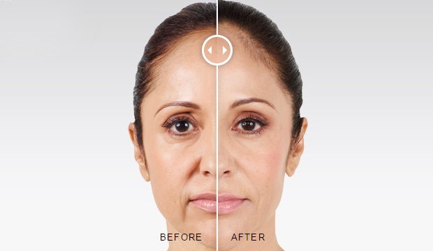 Juvederm® Injections Before and After Photo by Original Skin Med Spa and Laser Clinic in Broomfield CO Juvederm® Injections Before and After Photo by Original Skin Med Spa and Laser Clinic in Broomfield CO