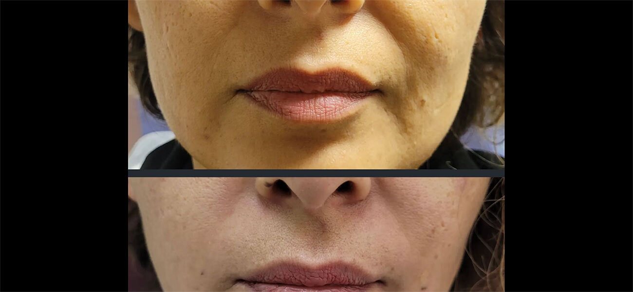 Nasalabial treatment done with Juvederm at Original Skin Med Spa and Laser Clinic located in Broomsfield, Colorado Nasalabial treatment done with Juvederm at Original Skin Med Spa and Laser Clinic located in Broomsfield, Colorado